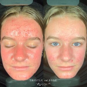 skin analysis machine before after 