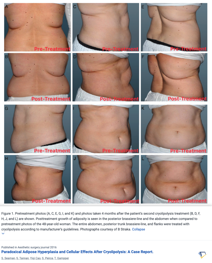 CoolSculpting PAH: The Paradoxical Adipose Hyperplasia Side Effect