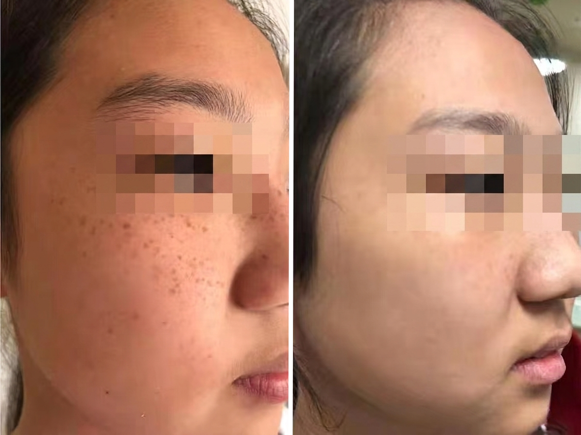 Pico Defyne Before & After Pigmentation