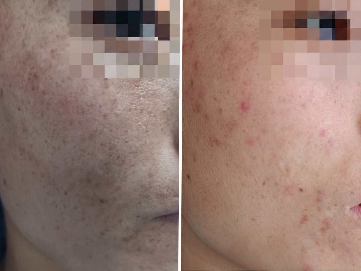 Pico Defyne Before & After Pigmentation