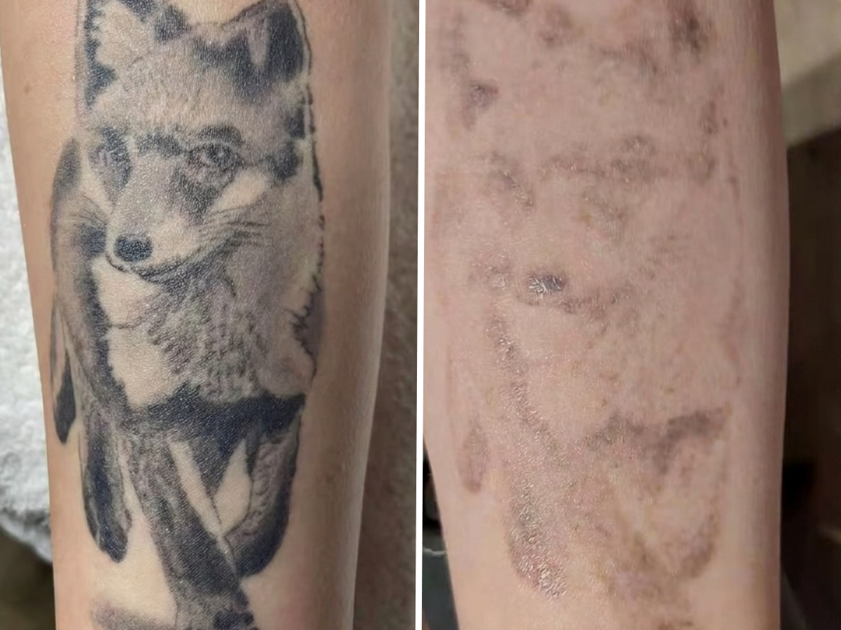 Pico Defyne Before & After Tattoo Removal