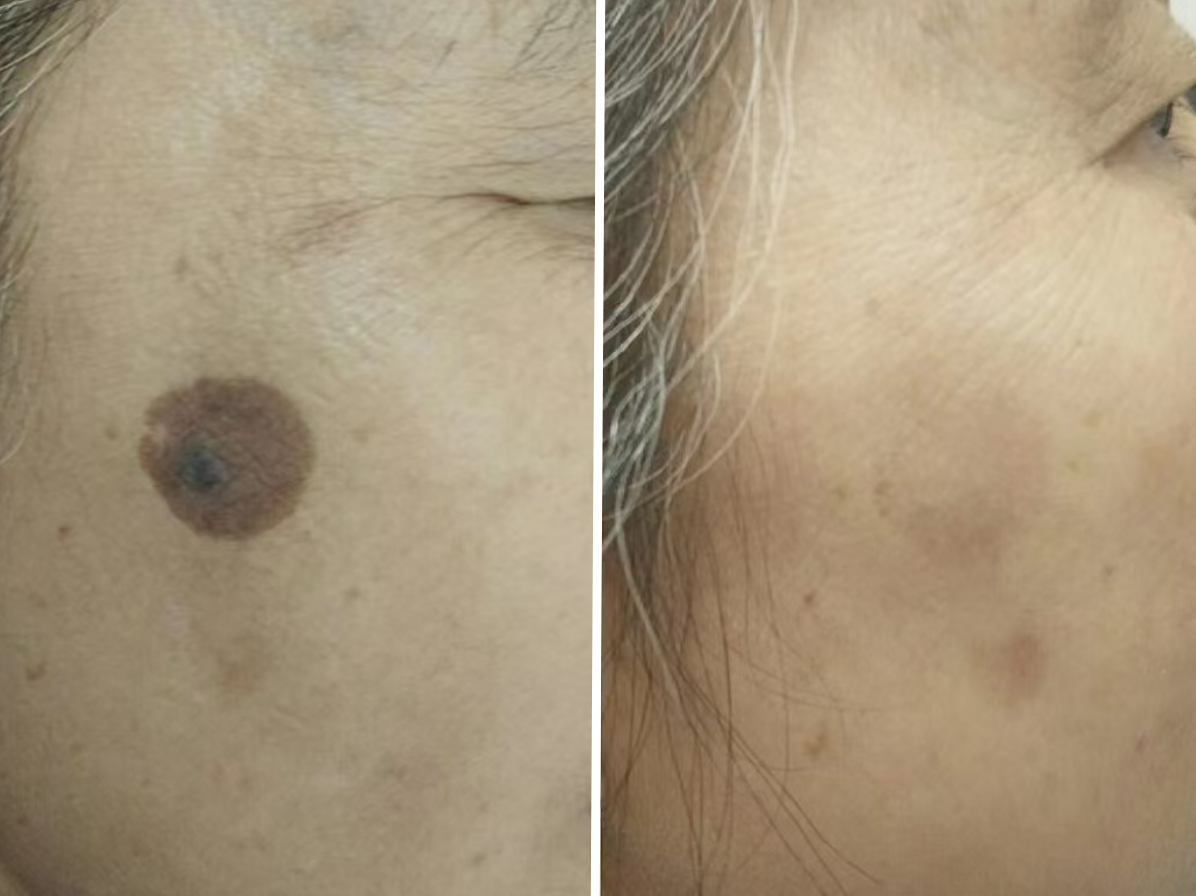 Pico Defyne Before & After Hyperpigmentation