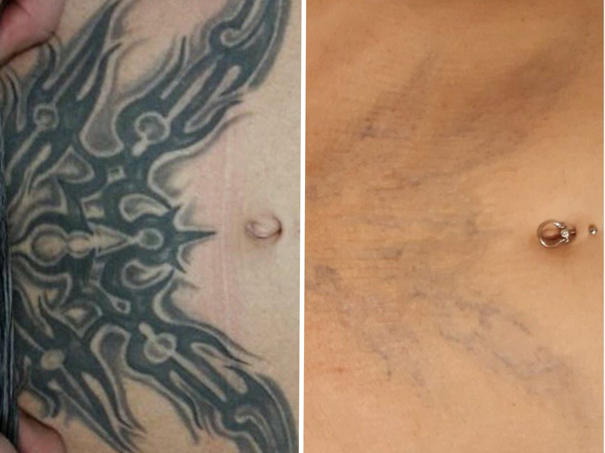 Pico Defyne Before & After Tattoo Removal