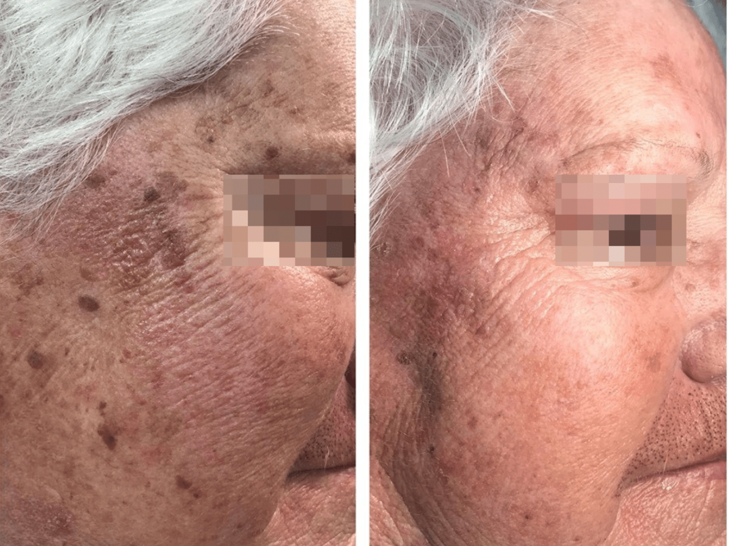 Pico Defyne Before and After