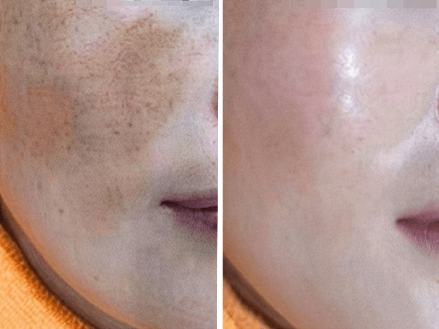 Pico Defyne Skin Clarity Before and After