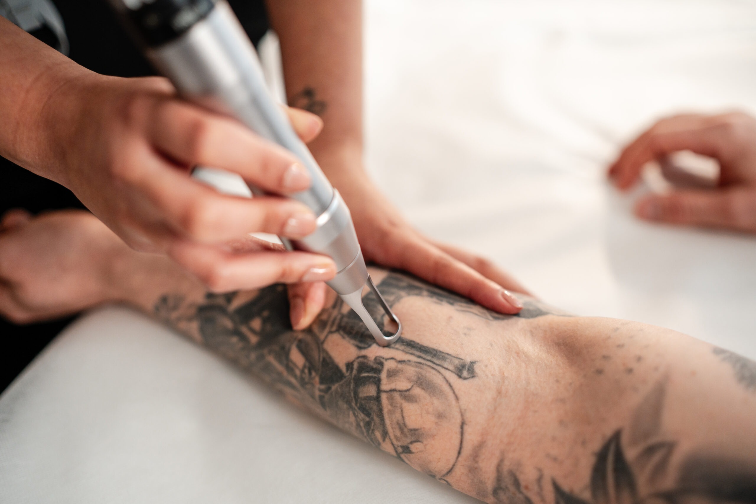 Pico Defyne Tattoo Treatment Image