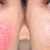 rosacea rosacea